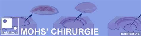 Schema dat het proces van Mohs' micrografische chirurgie illustreert.