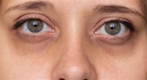 Infographic die de verschillende soorten wallen en de oorzaken van donkere kringen uitlegt.