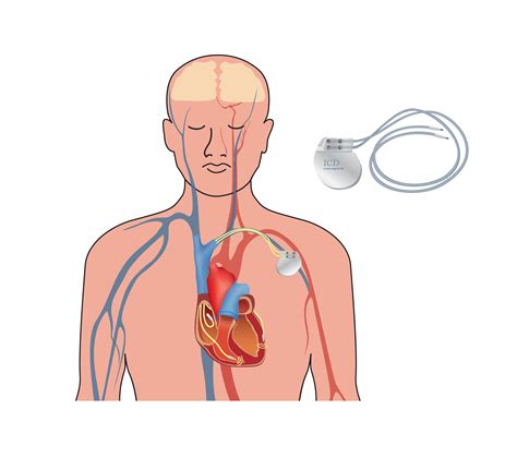 Illustratie van een ICD-apparaat in het lichaam