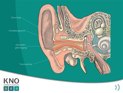 Illustratie van oorsmeerafzetting in een gehoorgang en bij een hoorapparaat